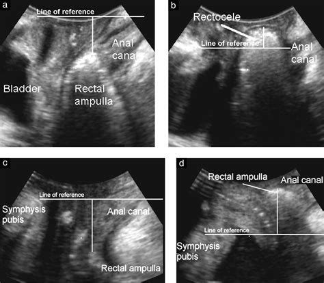 Ultrasound In The Investigation Of Posterior Compartment Vaginal Hot