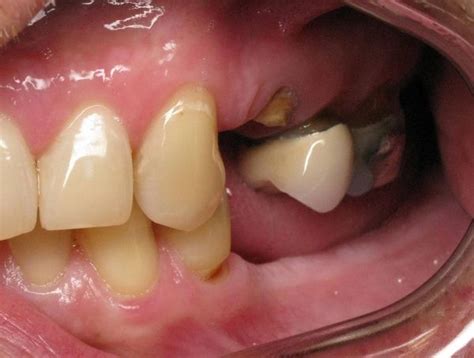 Mini Dental Implants For The Thin Ridge Back Molar Teeth Can Be