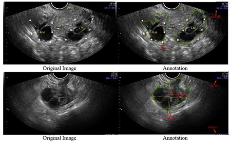 Ovarian Cancer Ultrasound