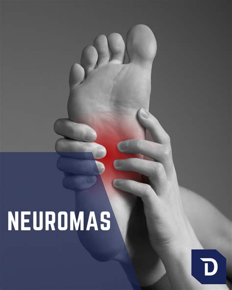 Mortons Neuroma Treatment Foot Alexandria Northern Va