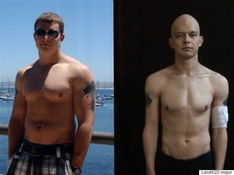 Testicular Cancer Fighter Shares Positive Before And After Chemo