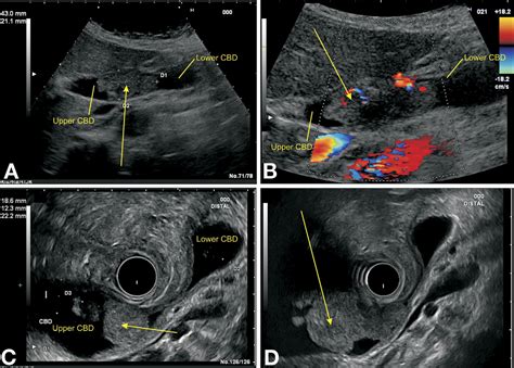 An Unusual Endoscopic Ultrasound Image Of The Common Bile Duct Gastroenterology