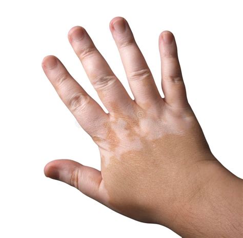 Vitiligo Stock Photo Image Of Vitiligo Sick Limb Skin 10048324