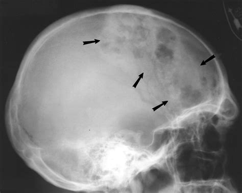 Imaging Findings Of Fibrous Dysplasia With Histopathologic And