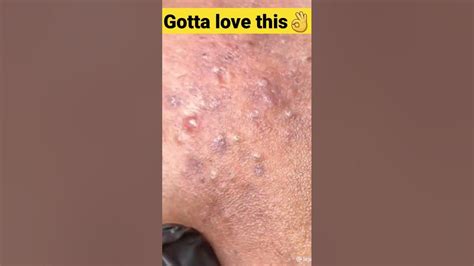 Lets Pop Some Pimples 💦 Popping Huge Blackheads And Pimples Pimple