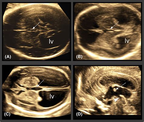 The Third Ventricle Of The Human Fetal Brain Normative Data And