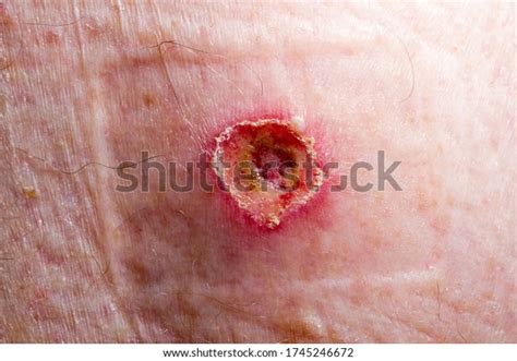 Wound Keratoacanthoma Three Days After Treatment Stock Photo 1745246672