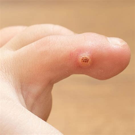 Plantar Wart Treatment Foot And Ankle Specialists Of Central Pa