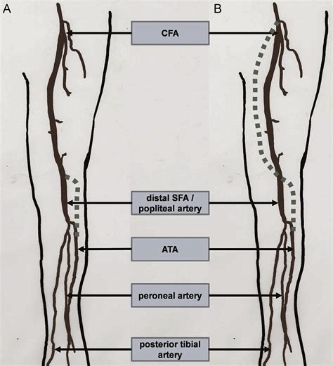 Lateral Approach To The Distal Femoral Artery In Femoro Anterior Tibial