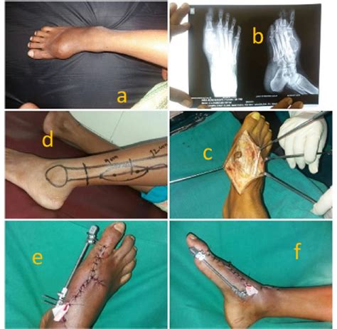 A Case Of Osteosarcoma Of First Metatarsal B X Ray Of Foot Showing Download Scientific Diagram