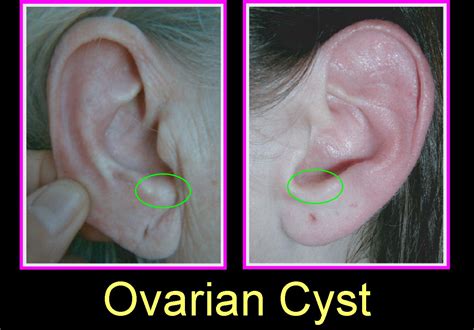 Ovarian Cyst Ovarian Cysts