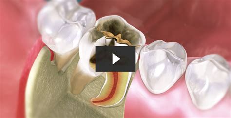 Root canals are a controversial topic in the dental world (if you didn't know!). Repairing Tooth Decay with Root Canal and Crown - 89A ...