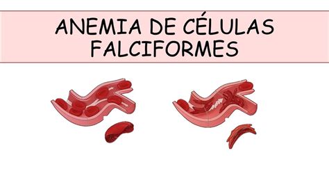 Anemias De Células Falciformes Talasemias Udocz