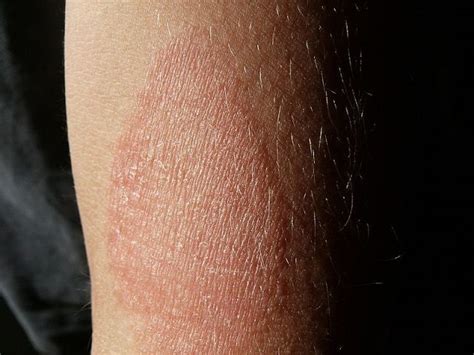Dermatite Atopica Cos Quali Sono I Sintomi E Come Si Cura Questa