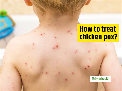 Chicken Pox Causes Symptoms Complications Treatment And Prevention