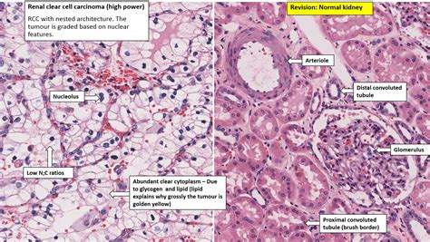 Kidney Renal Cell Carcinoma Nus Pathweb Nus Pathweb