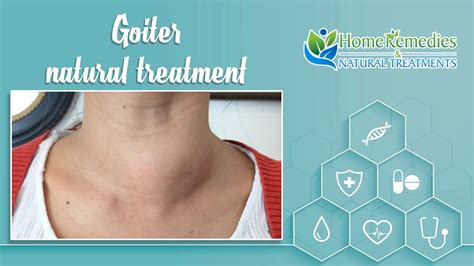 Natural Treatments And Home Remedies For Goiter Youtube