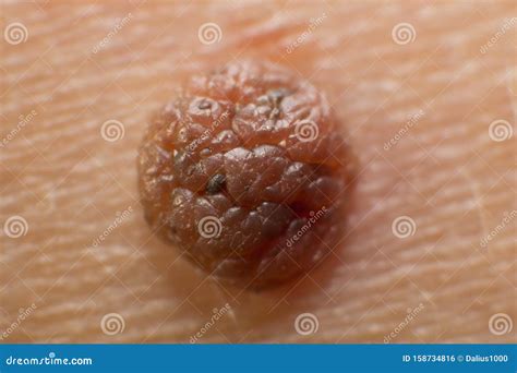 Mole On The Skin Of The Body Birthmark Stock Photo Image Of