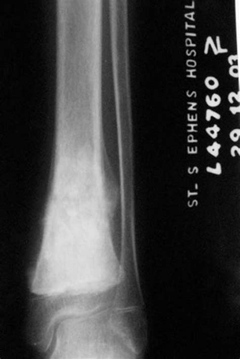 Chondroblastic Osteosarcoma Of The Lower Tibia A Case Report The