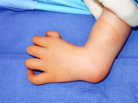 Congenital Hand And Arm Differences