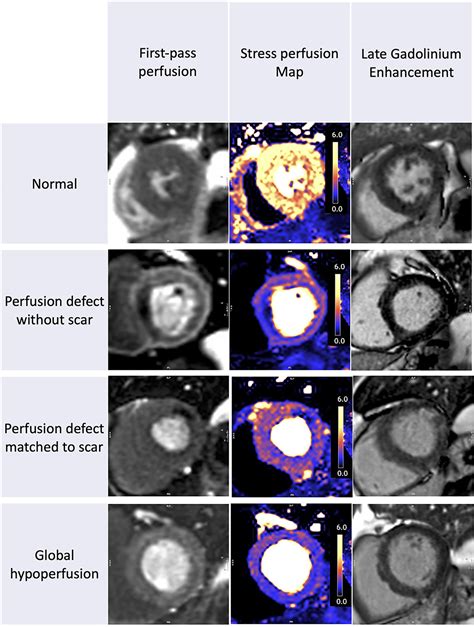 Frontiers Myocardial Perfusion Imaging After Severe Covid 19