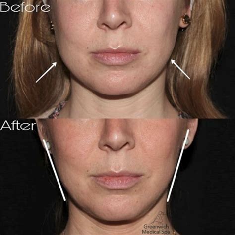 An Amazing Before And After Patient Who Used Botox In Her Masseter Muscles To Slim Down Their