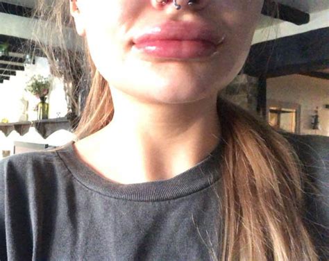 botched lip fillers woman shocked as clinic blames yellow pus on oral sex daily star