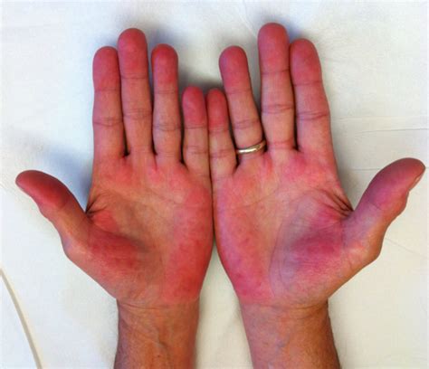 Red Palms An Unusual Symptom Of Cirrhosis Of The Liver When Should