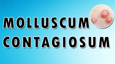 Molluscum Contagiosum Treatment Cream Virus And Symptoms Dermatology