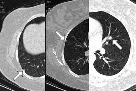 The Pulmonary Spiral Ct Indicating Noncalcified Solid Nodules Randomly