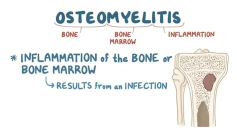 Osteomyelitis A Look At What It Is How To Diagnose And Treat It