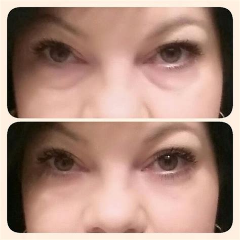 Before And After Instantly Ageless Instantly Ageless Ageless Years