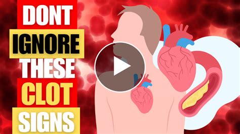 Silent Signs Of A Blood Clot You Should Not Ignore Health Life Guru