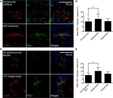 Pdl1 Is Expressed In Tumor Associated Lymphatic Vessels Lvs A