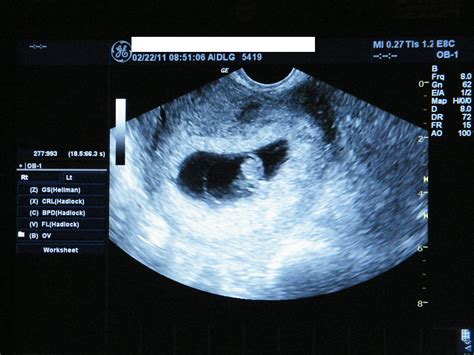 Ultrasounds Of Twins At 8 Weeks Pregnant Images