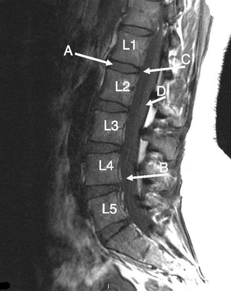 Lumbar Spine Sagittal