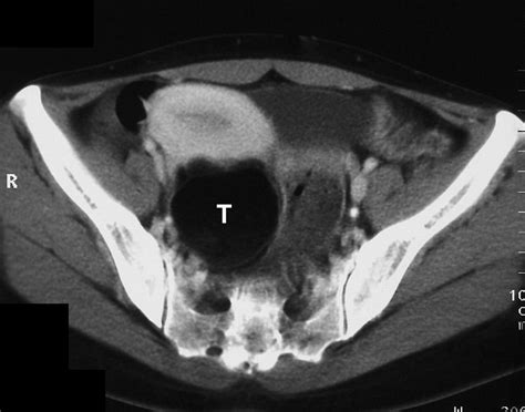 Atypical CT And MRI Manifestations Of Mature Ovarian Cystic Teratomas AJR