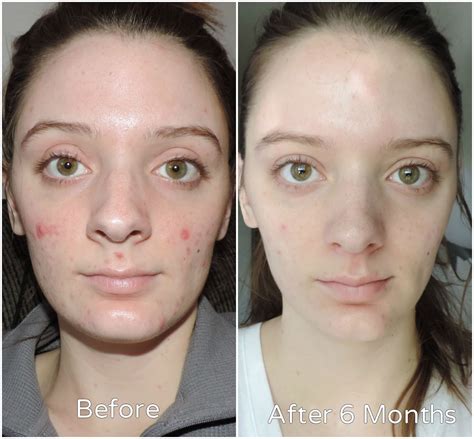 Retinol serum purge - Eucrea