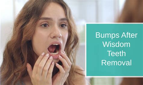 Bumps After Wisdom Teeth Removal Teeth Shakers Dental Care By Dentists