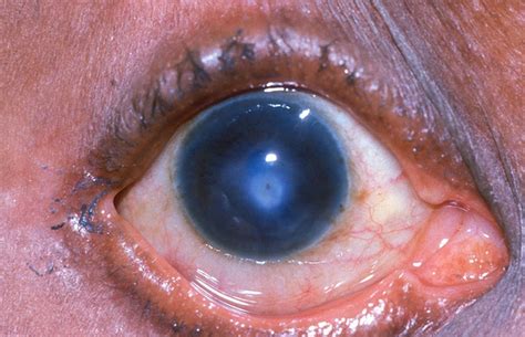 Homoeopathic Remedies For Corneal Ulcer