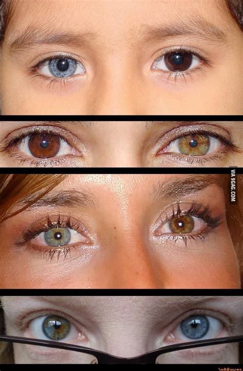 Heterochromia Iridis A Condition In Which The Iris Is Composed Of Different Colored Segments Or
