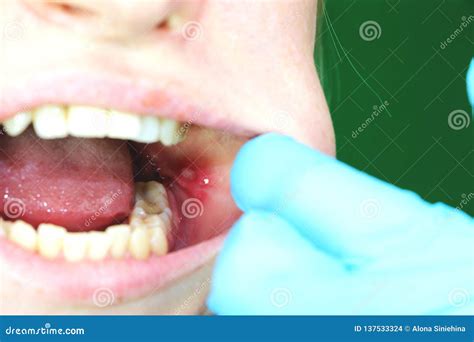 Painful Ulcer And Stomatitis On The Mucous Cheek Of A Girl After The