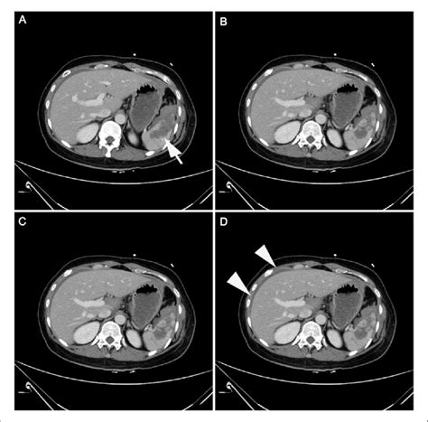 Preoperative Computed Tomography Scan Images Showing A Grade Iv Splenic