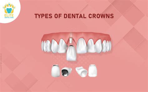 Types Of Dental Crowns Elite Dental Care