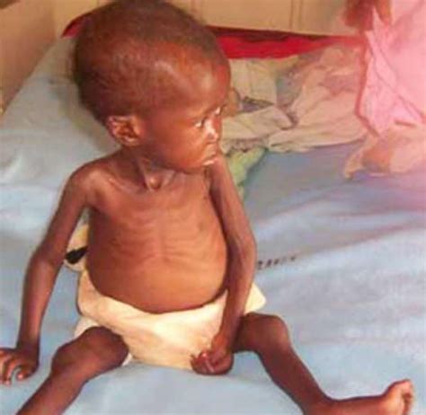 80 Babies Malnourished