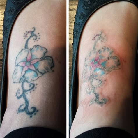 Top Tattoo Art Laser Tattoo Removal After One Session