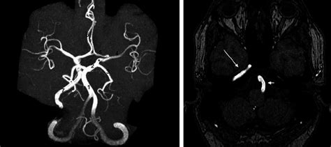 Left Internal Carotid Artery Agenesis In A Year Old Woman With