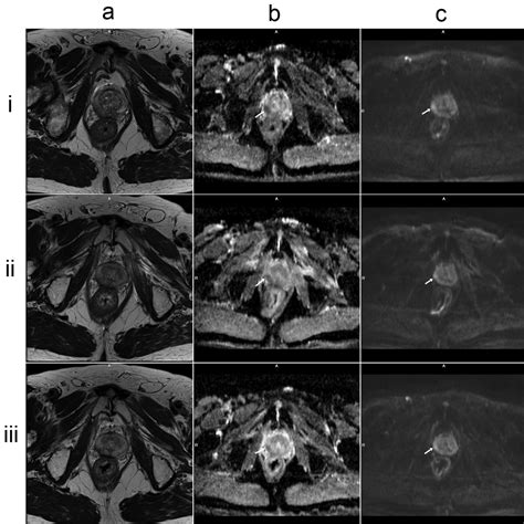 Diffusion Weighted MRI Provides A Useful Biomarker For Evaluation Of Radiotherapy Efficacy In