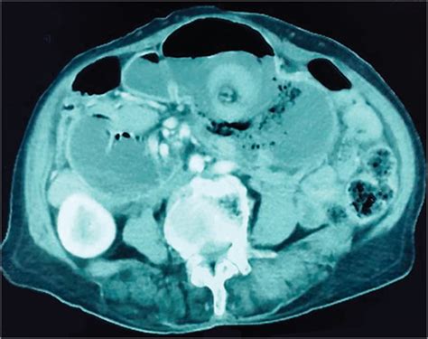 Elderly Woman With Acute Abdomen And Gastric Mass On Imaging