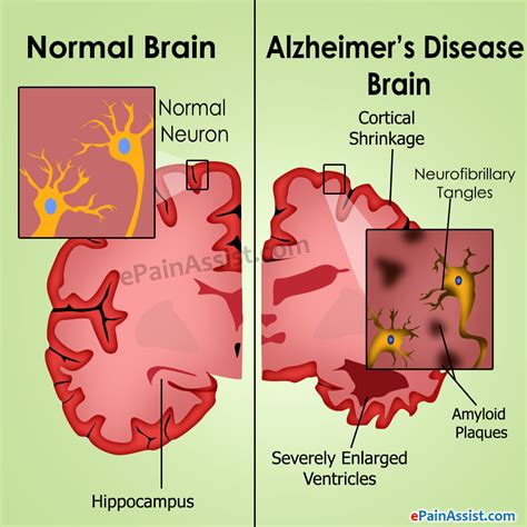 Alzheimers Disease Causesstagestreatmentprognosis